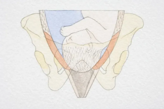 Framed Print : Section diagram of swollen uterus with foetus head pushing through the dilated cervix opening Framed Print : Section diagram of swollen uterus with foetus head pushing through the dilated cervix opening