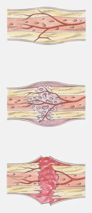 Framed Print : Sequence of illustrations showing complete bone fracture and healing process Framed Print : Sequence of illustrations showing complete bone fracture and healing process
