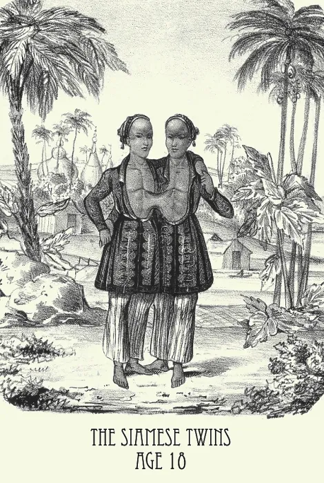 Framed Print : The Siamese Twins age 18 Framed Print : The Siamese Twins age 18