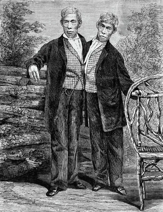 Framed Print : Siamese Twins Attached at Chest Framed Print : Siamese Twins Attached at Chest