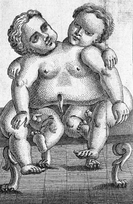 Framed Print : Siamese twins born in Palermo in 1755, Sicily, Italy, Historical, digitally restored reproduction from a 19th century original Framed Print : Siamese twins born in Palermo in 1755, Sicily, Italy, Historical, digitally restored reproduction from a 19th century original