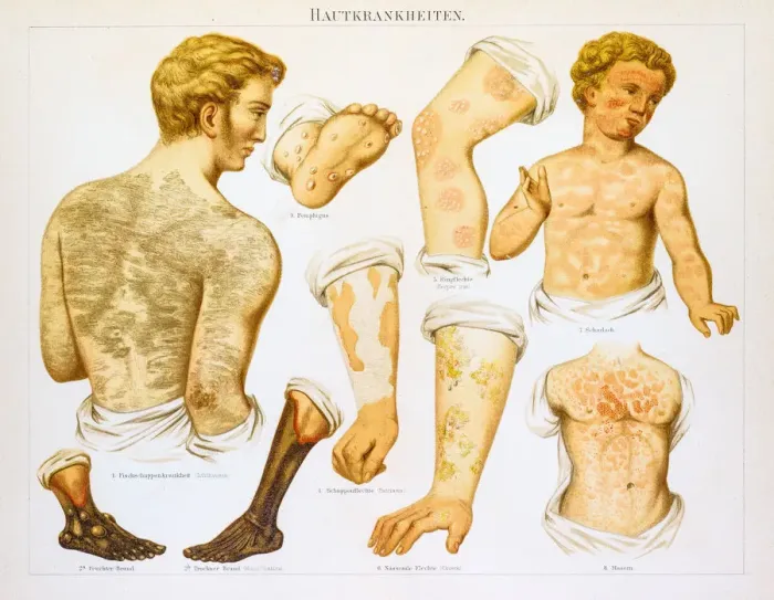 Framed Print : Skin diseases lithography 1895 Framed Print : Skin diseases lithography 1895
