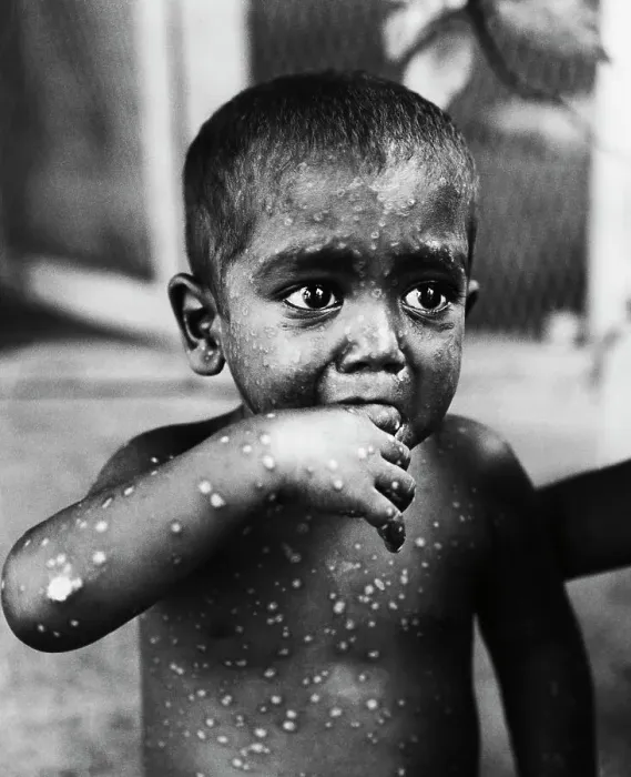 Framed Print : Small Boy Suffering from Smallpox Framed Print : Small Boy Suffering from Smallpox