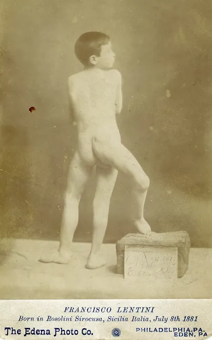 Framed Print : Souvenir Cabinet Card of Three-Legged Boy, Francisco Lentini, circa 1890 Framed Print : Souvenir Cabinet Card of Three-Legged Boy, Francisco Lentini, circa 1890