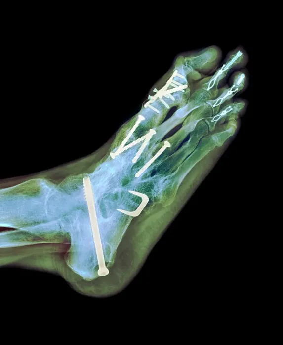 Framed Print : Surgical fixation for rheumatoid arthritis of feet, X-ray Framed Print : Surgical fixation for rheumatoid arthritis of feet, X-ray