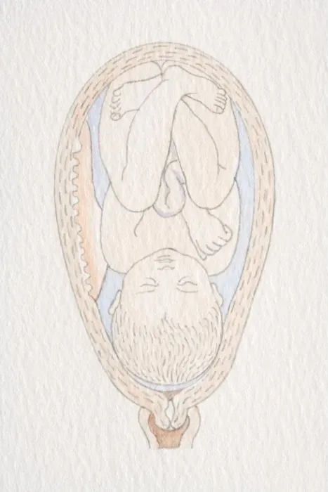 Framed Print : Swollen womb with inverted foetus head pointing to cervix opening Framed Print : Swollen womb with inverted foetus head pointing to cervix opening