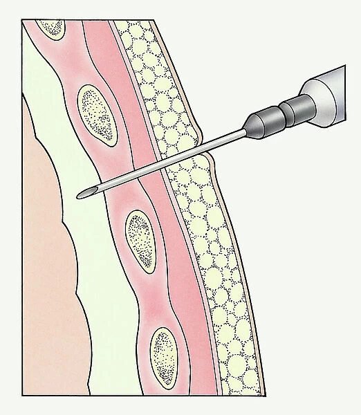 Syringe entering pleural membranes around human lung to extract sample