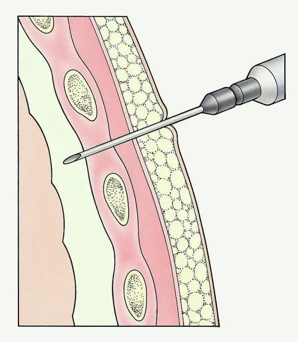 Framed Print : Syringe entering pleural membranes around human lung to extract sample Framed Print : Syringe entering pleural membranes around human lung to extract sample