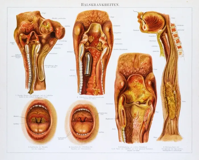 Framed Print : Throat diseases lithography 1895 Framed Print : Throat diseases lithography 1895