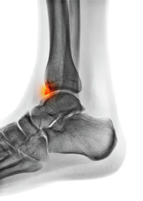 Framed Print : Tibial spur, X-ray Framed Print : Tibial spur, X-ray