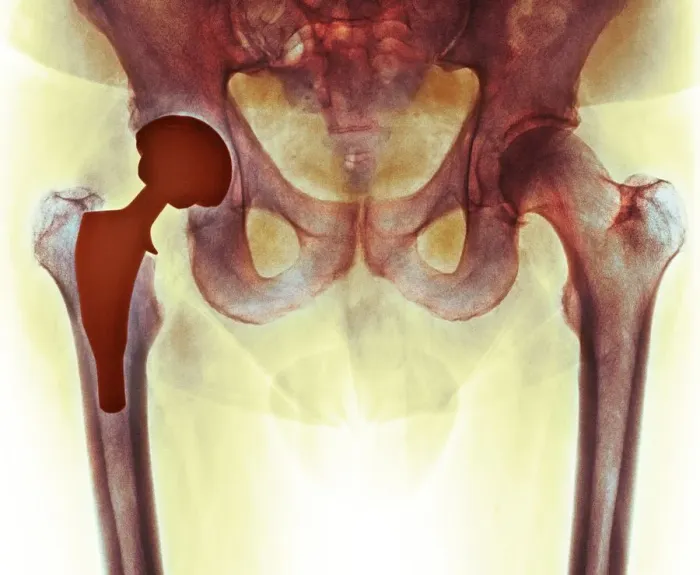 Framed Print : Total hip replacement, X-ray
