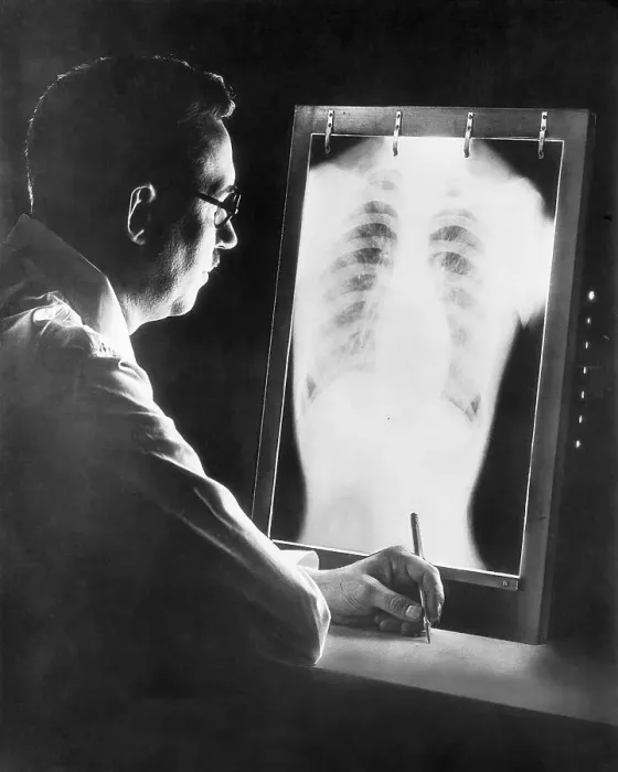 Framed Print : Tuberculosis X-Ray