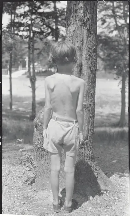 Framed Print : Back View of Child with Tuberculosis Framed Print : Back View of Child with Tuberculosis