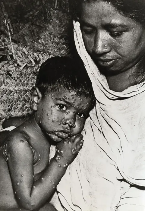Framed Print : Woman Holding Boy with Smallpox Framed Print : Woman Holding Boy with Smallpox