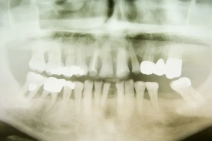 Framed Print : X-ray image of a human jaw with treated teeth, Germany, Europe Framed Print : X-ray image of a human jaw with treated teeth, Germany, Europe