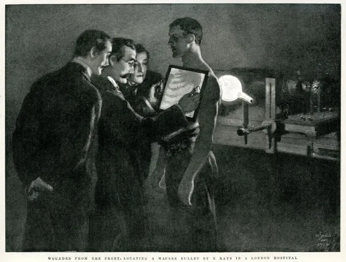 Framed Print : X-Rays of a Wounded Solider Framed Print : X-Rays of a Wounded Solider