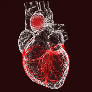 Ascending Aorta Aneurysm Print Ascending Aorta Aneurysm Print