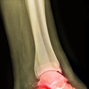 Arthritic ankle, X-ray
