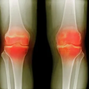 Arthritic knees, X-ray Arthritic knees, X-ray