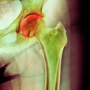 Arthritis of the hip, X-ray Arthritis of the hip, X-ray