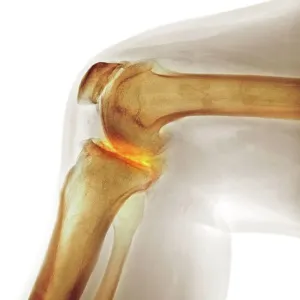 Arthritis of the knee, X-ray Arthritis of the knee, X-ray