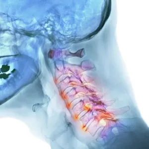 Arthritis of the neck, X-ray Arthritis of the neck, X-ray