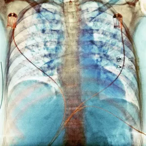 Aspiration, chest X-ray Aspiration, chest X-ray