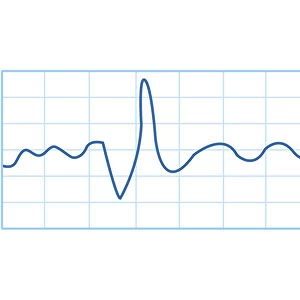 Biomedical illustration of electromyography (EMG) result