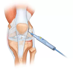 Bovie used to cut through retincaculum, and clean up femur of Displaced patellar knee