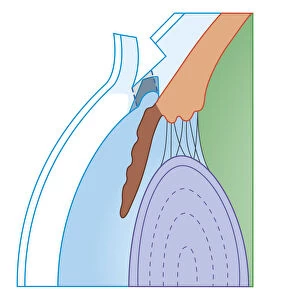 Cross section biomedical illustration of Trabeculectomy, surgical technique used to treat chronic glaucoma