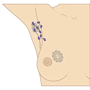 Cross section biomedical illustration of breast cancer tumour and lymph nodes requiring lumpectomy procedure