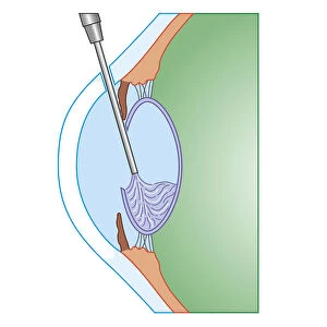 Cross section biomedical illustration of eye cataract surgery sucking softened tissue out using ultrasound probe inserted into lens via incision in cornea
