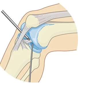 Cross section biomedical illustration of inside the knee joint during rigid endoscopy procedure