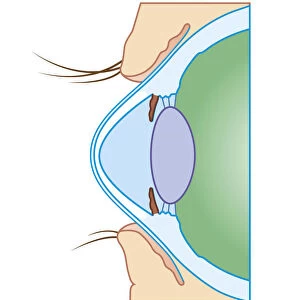 Cross section biomedical illustration of keratoconus or conical cornea