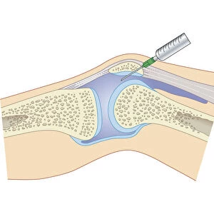 Cross section biomedical illustration of removing synovial fluid from knee using joint aspiration