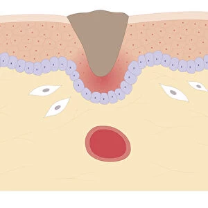 Cross section biomedical illustration of skin repair with fibroblast forming plug within Thrombus (blood clot) which contracts and plug shrinks and new skin tissue forms underneath