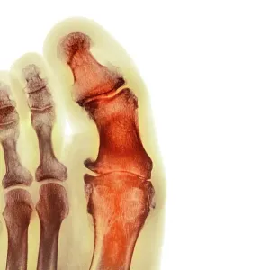 Degenerative foot deformation, X-ray Degenerative foot deformation, X-ray