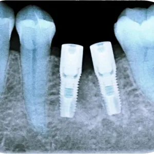 Dental implants following tooth extraction, X-ray Dental implants following tooth extraction, X-ray