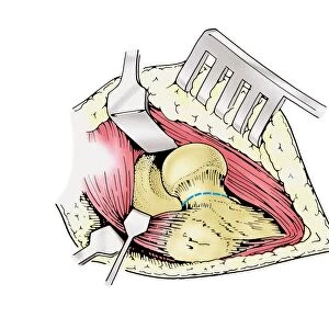 Diagram showing removal of affected head of a femur bone