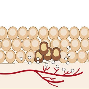 Digital illustration of angiogenesis process showing dormant tumour invading tissue, growing to mali