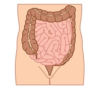 Digital illustration of location of intussusception in small intestine