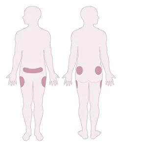 Digital illustration representing areas of fat distribution on belly, hips and thighs