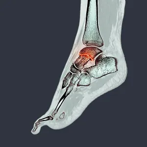 Fractured ankle bone, CT scan Fractured ankle bone, CT scan