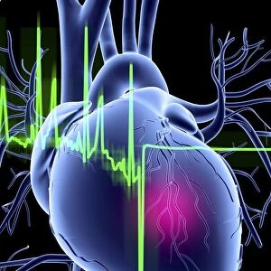 Heart attack and ECG trace