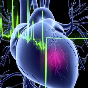 Heart Attack ECG Print Heart Attack ECG Print