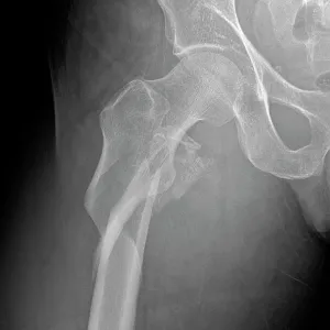 Hip fracture, X-ray Hip fracture, X-ray