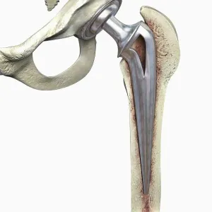 Hip replacement