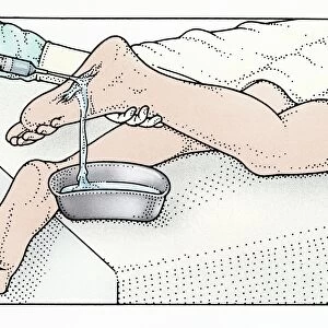 Illustration of using syringe to clean wound on sole of foot