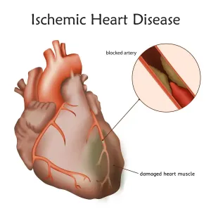 Ischemic Heart Disease Print: Damaged Heart Muscle from Blocked Artery Ischemic Heart Disease Print: Damaged Heart Muscle from Blocked Artery