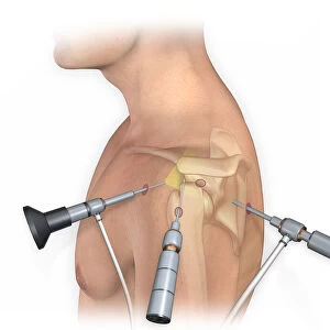 Lateral view of arthroscopic surgical repair on the shoulder joint